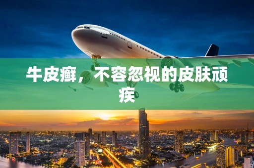 牛皮癣，不容忽视的皮肤顽疾